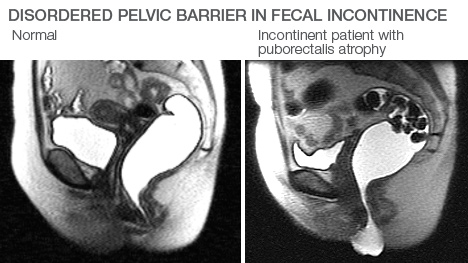 Photograph of a scan showing a healthy patient on the left and a patient with fecal incontinence on the 