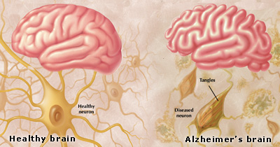 Common Eye Disease Not Tied to Dementia