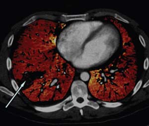 Image of dual energy CT visualizing blood perfusion deficits