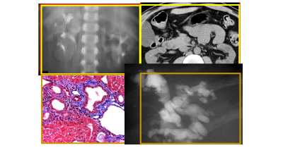 The kidneys of ARPKD patients surviving the neonatal period often decrease in size and become fibrotic.