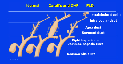 Origin of biliary fibrocystic disease in ARPKD and ADPKD.