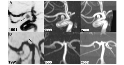 Stability of two small intracranial aneurysms detected by presymptomatic screening.