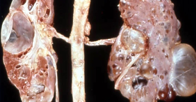 Moderately advanced ADPKD.