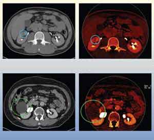 Images from two dual-energy CT urogram cases