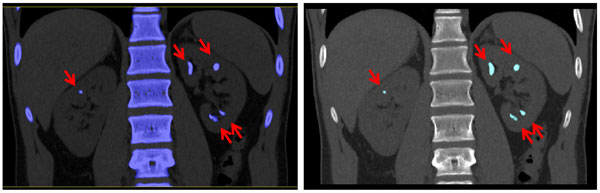 Image of renal stones