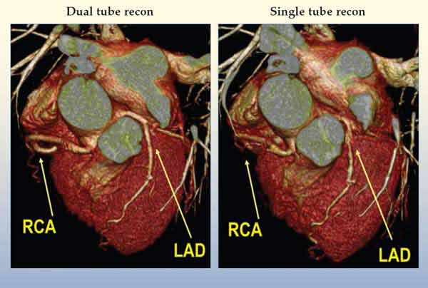 Temporal resolution in Cardiac CT: 83 vs. 165 ms