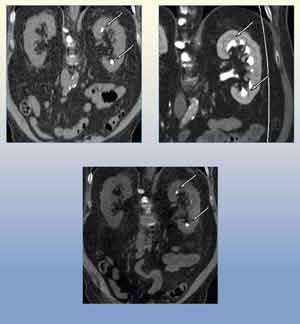 Image of a dual energy CT urogram study