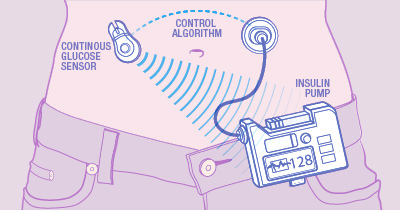 Illustration of how an artificial pancreas functions