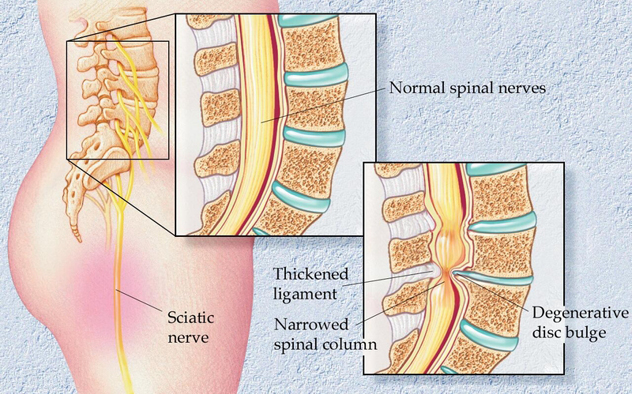 Lumbar spinal stenosis