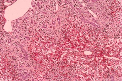 Histology of acute liver injury secondary to drug overdose