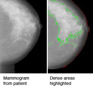 Images showing computerized algorithm for estimating percent of breast density.
