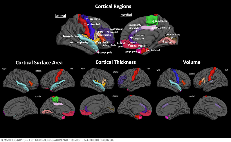 Brain regions that comprise the chronic migraine versus episodic migraine classifiers are pictured.