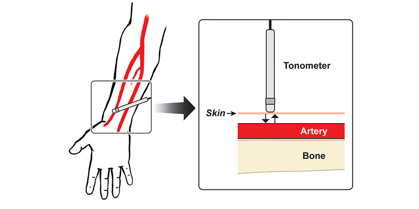 kullo peripheral artery disease