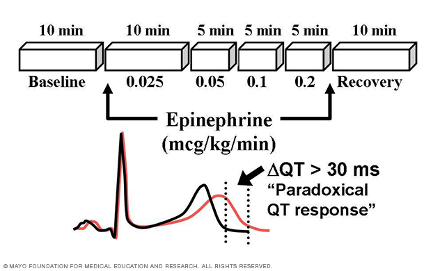 Figure showing long QT syndrome stress test