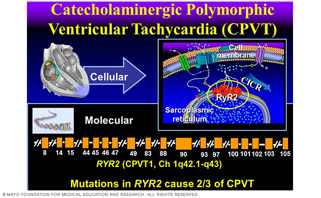 Image showing catecholaminergic polymorphic ventricular tachycardia