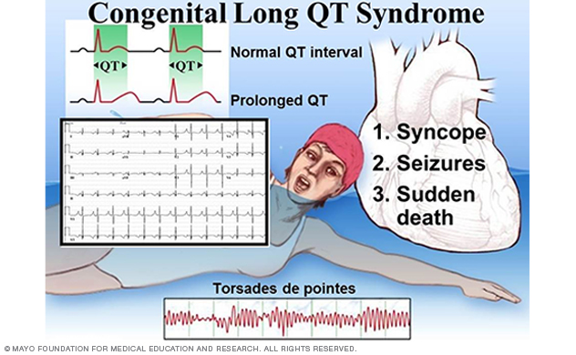 Image showing clinical characteristics in congenital long QT syndrome