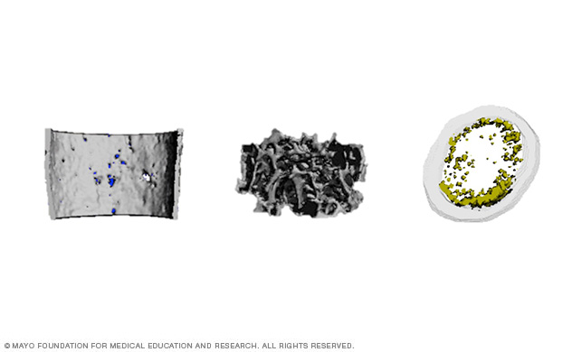 Microcomputerized tomography reconstructions of cortical bone on the left, cancellous bone in the middle and bone marrow fat on the right in Hdac3-depleted mice. Credit: Meghan McGee-Lawrence, Ph.D., Dana L. Begun, Ph.D.