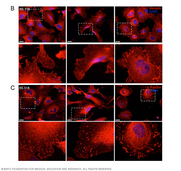 6-panel microscopy collage with boxes drawn within the panels to pinpoint cancer cells