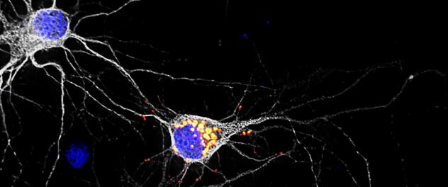 Dr. Rossoll's team is utilizing cutting-edge methods to identify ways to prevent the formation of pathological protein aggregates in neurons.
