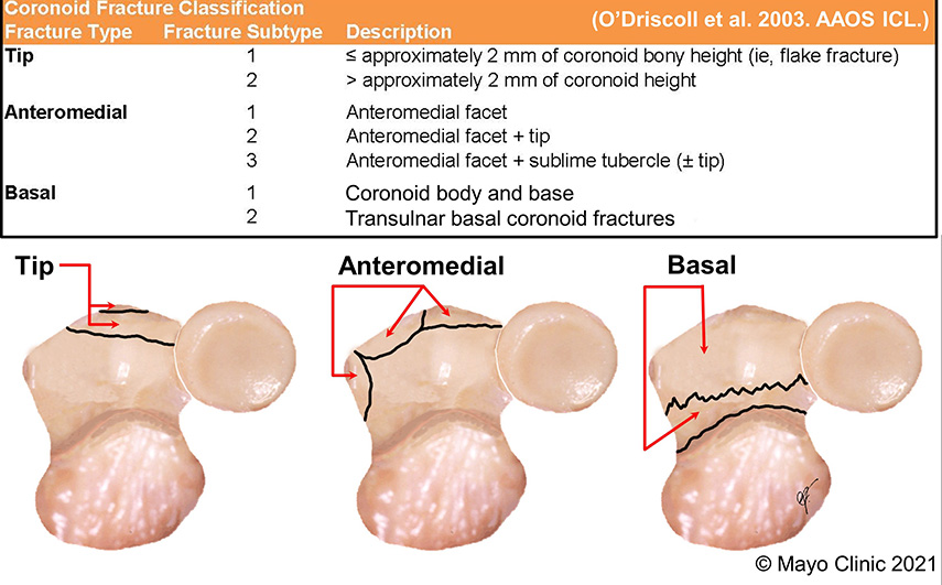 Dr. O'Driscoll's coronoid fracture classification system includes fracture type and subtype and description.