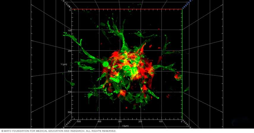 3D spheroids matrigel culture of brain tumor stem cells and neural stem cells