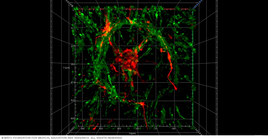 Real-time video microscopy shows organotypic culture model used to study the migration of brain tumor stem cells in 3D ex vivo.