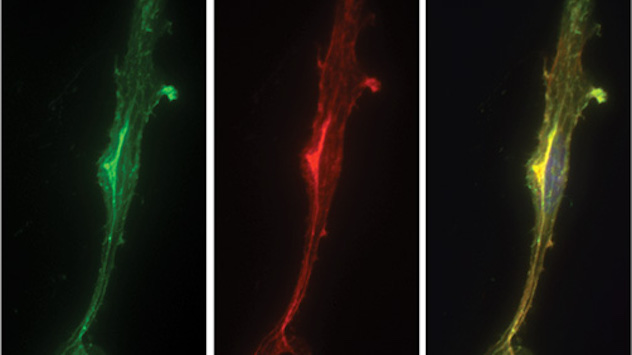 The NKCC1 ion cotransporter, a channel highly expressed in brain cancer cells, is found to affect the cytoskeleton in such a way that allows cancer cells to be highly migratory.