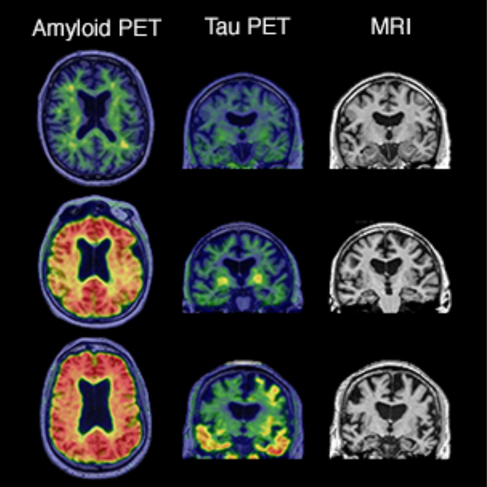 Three brain scan panels showing amyloid PET, tau PET and MRI results