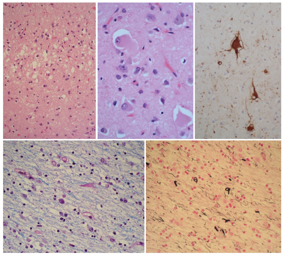 Corticobasal degeneration histopathology microscopy
