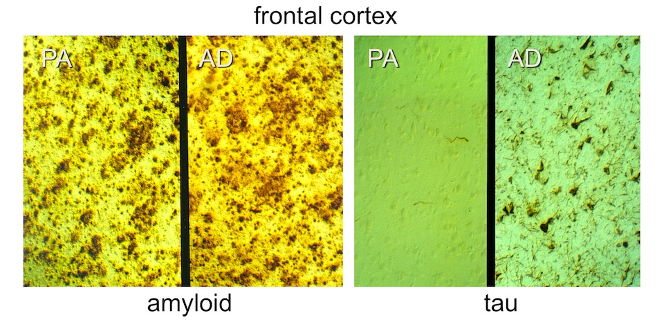 Frontotemporal dementia microscopic findings