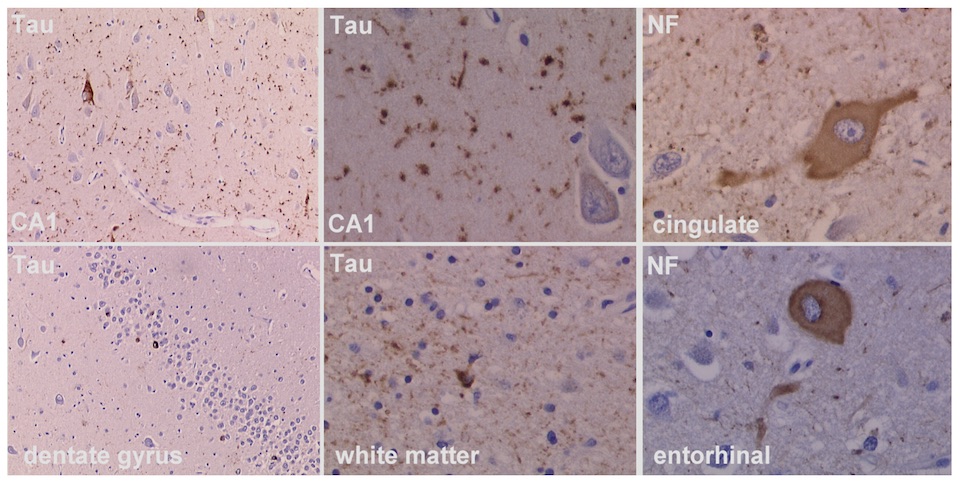 Argyrophilic grain disease as seen under the microscope