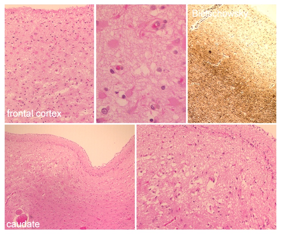 Frontotemporal dementia TDP microscopic findings