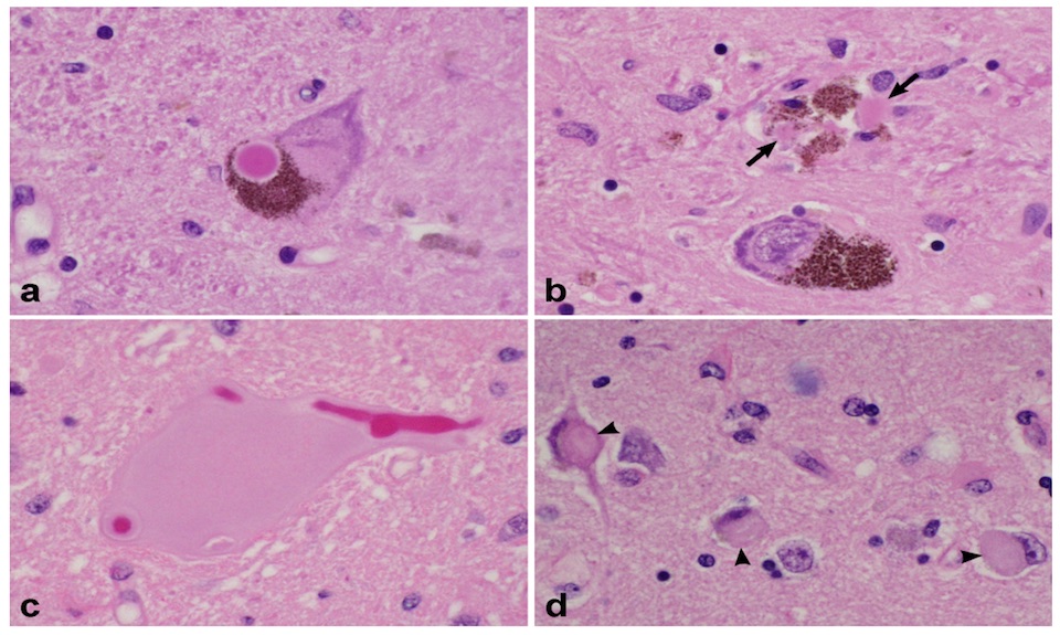 Slides showing Lewy body disease