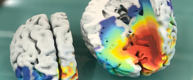 3D-printed brain with a gradient of colors representing cell density in glioblastoma. Only higher cell densities are visible on MRI; this brain also shows lower cell densities as given by a mathematical model.