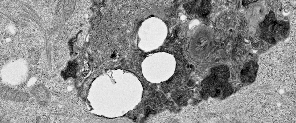 An image showing an electron micrograph of an autophagic structure in a hepatocellular carcinoma cell