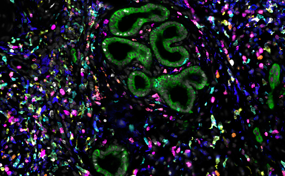 Microscopy image showing staining for cholangiocytes vs. immune cells