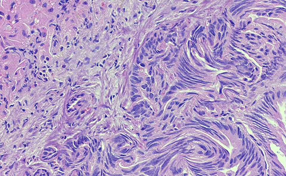 Microscopy image showing CCA histology in a patient