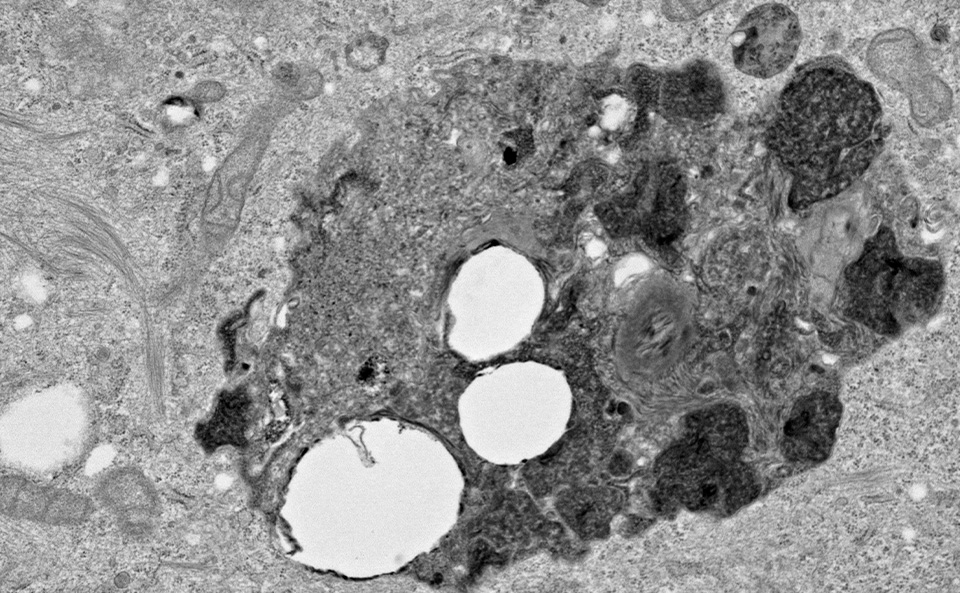 Microscopy image showing an electron micrograph of an autophagic structure in hepatocellular carcinoma cell