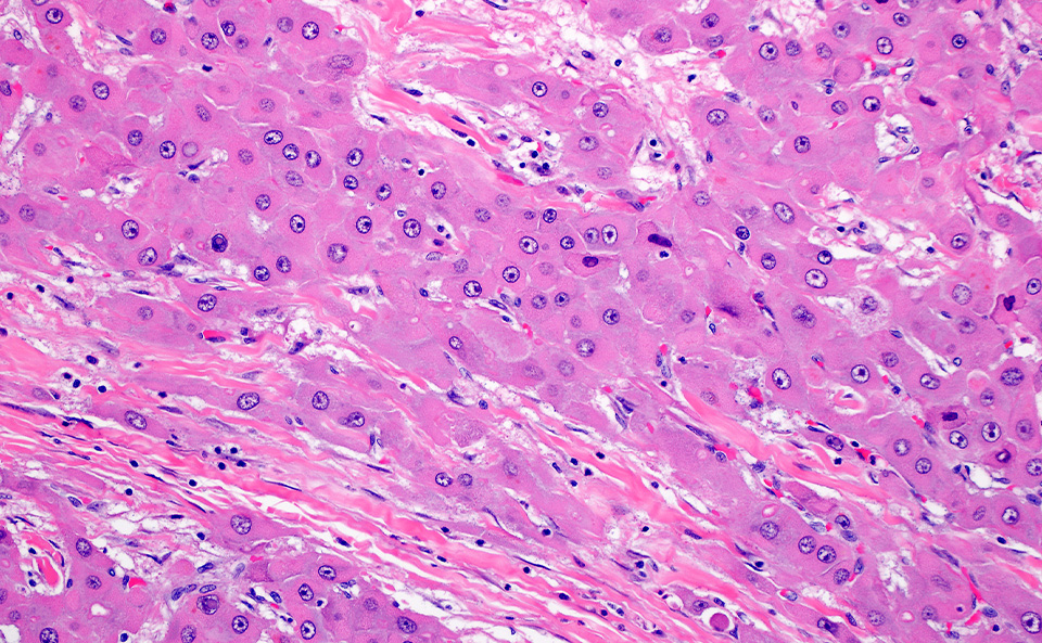 Microscopy image showing fibrolamellar hepatocellular carcinoma