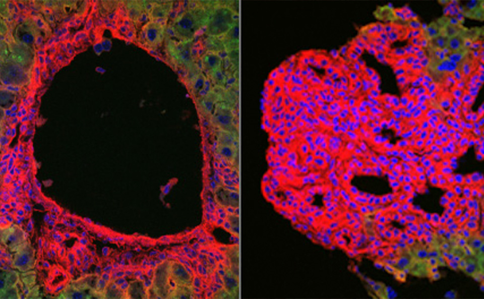 Microscopy image showing CCA nodules derived from nonliver parenchyma