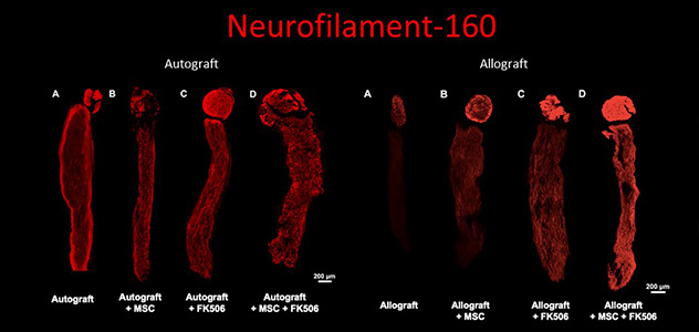 Illustration showing nerve regeneration after treatment