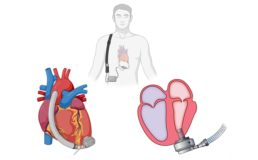 Illustration showing how correction of valve pathologies is likely important for LVAD outcomes