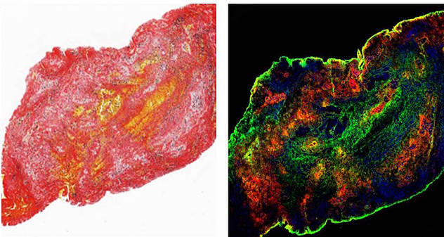 Confocal images showing acute ischemic stroke clot.