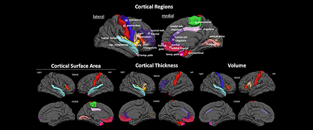 Brain regions that comprise the chronic migraine versus episodic migraine classifiers are pictured.