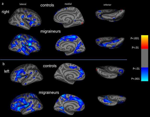 Atypical age-related cortical thinning in migraine patients is pictured. 