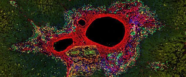 This image depicts diseased human liver tissue. Tissue stained in red shows fibrosis around the central vein. Tissue stained in green shows the bile ducts. Tissue stained in yellow shows immune cells. A white line is drawn around a region of interest on the image.