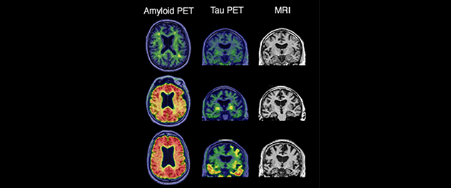 Three brain scan panels showing amyloid PET, tau PET and MRI results