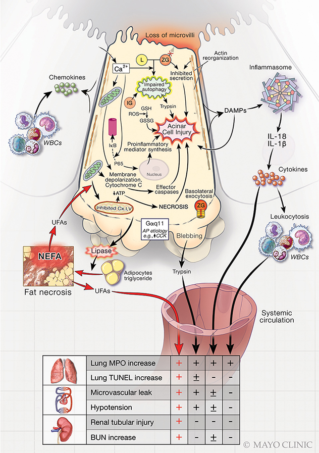 Image showing role of exocrine pancreas in systemic injury during acute pancreatitis from the Pancreatitis and Acute Outcomes Research Lab, led by Vijay P. Singh, M.B.B.S., M.D., at Mayo Clinic