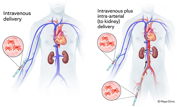 Medical illustration of two strategies to deliver mesenchymal stem cells