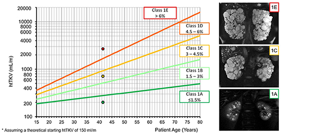 Graphical representation of the Mayo Image Classification for autosomal dominant polycystic kidney disease. The chart plots height-adjusted total kidney volume against patient age and categorizes patients into classes 1A through 1E based on estimated annual kidney growth rates. Colored trend lines represent increasing disease severity, from Class 1A (slow growth) to Class 1E (rapid growth). MRI scans on the right show representative kidney appearances for different Mayo Image Classification classes, demonstrating progressively larger kidneys and increasing cyst burden with more severe disease categories.
